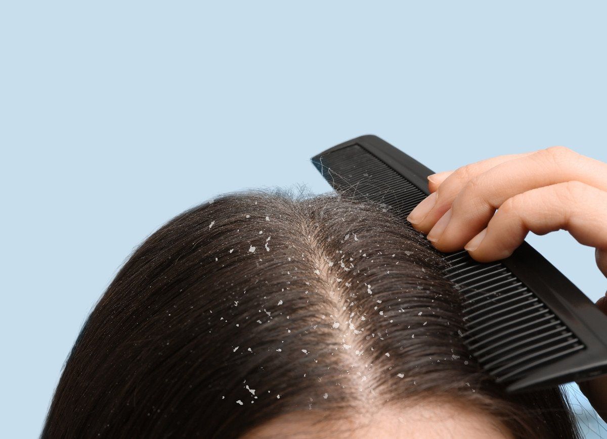 Dandruff - Just 4 areas to focus to beat it cleverly photo-of-the-dandruff