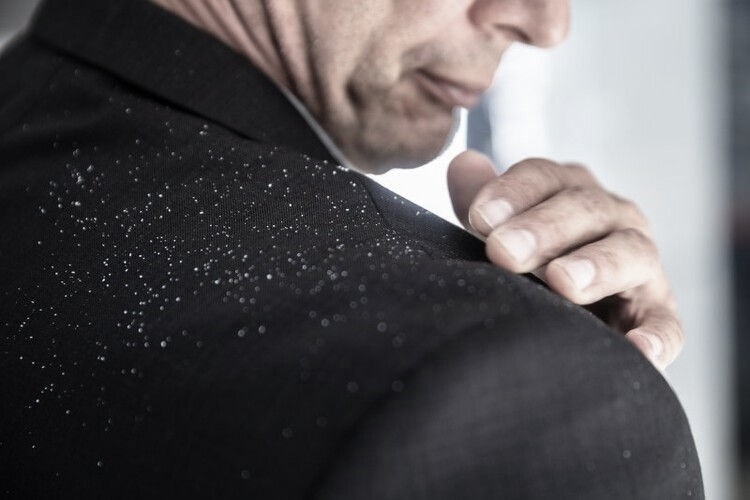 Dandruff – Just 4 areas to focus to beat it cleverly